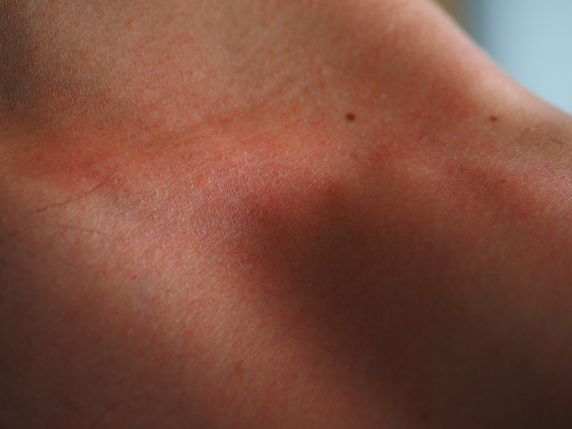 Eczema neonato: quali sono le sue cause? Come porvi rimedio?